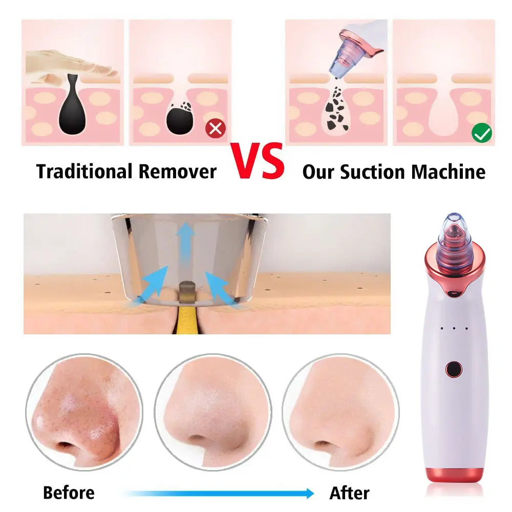 Electric Acne Remover Blackhead Remover Apparatus - Shakefav.com