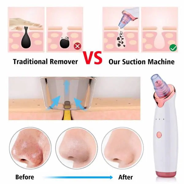 Electric Skin blackhead Vacuum Facial Blackhead Remover - Shakefav.com