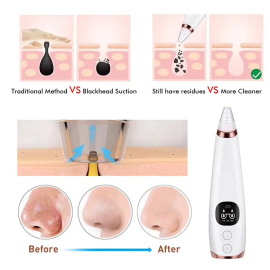 Facial microcry stalline blackhead skin beauty instrument - Shakefav.com