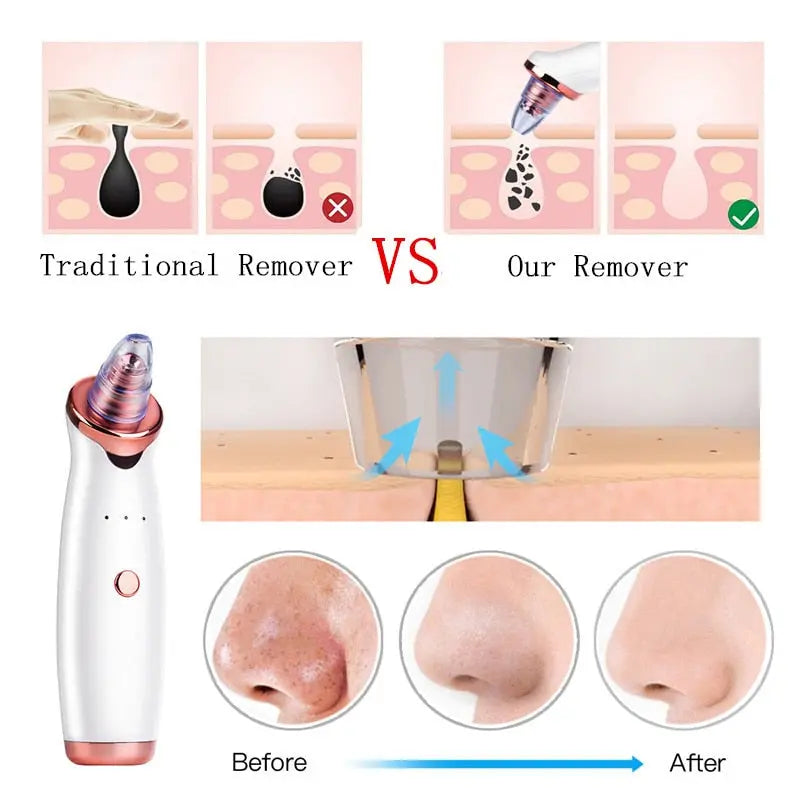 Facial Blackhead Remover Electric Vacuum Machine - Shakefav.com